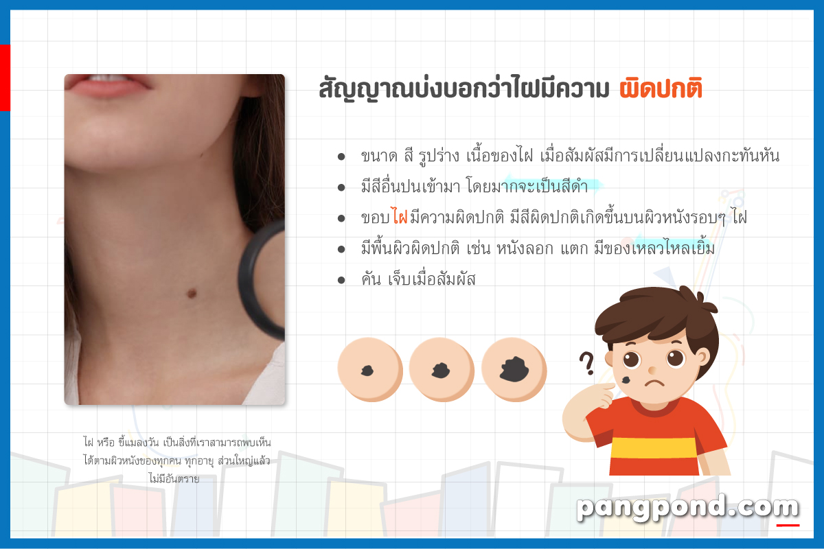 ไฝเกิดจากอะไร 9 ขี้แมลงวันเป็นสิ่งที่เราท่านสามารถพบเห็นได้? 3 ความผิดปกติของไฝ